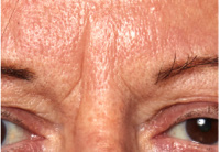 Forehead wrinkles: first (upper) photograph in the supplied study