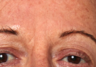 Forehead wrinkles: second (lower) photograph in the supplied study