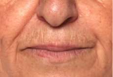 Upper lip lines: first (upper) photograph in the supplied study