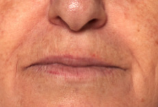 Upper lip lines: second (lower) photograph in the supplied study