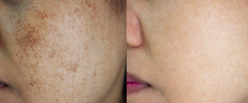 Pigmentation
