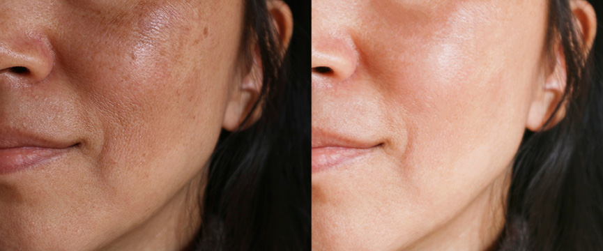 Skin Tightening